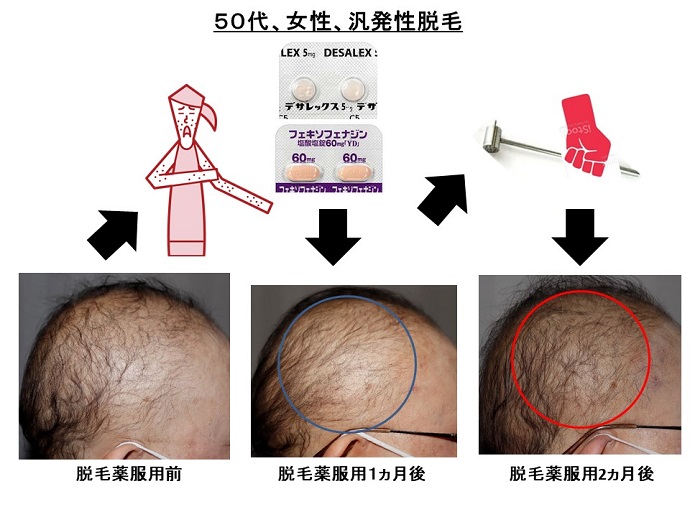 円形脱毛症　病院